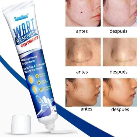 Wart Remover - Renovedor de verrugas D