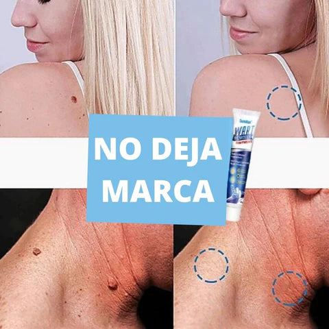 Wart Remover - Renovedor de verrugas D